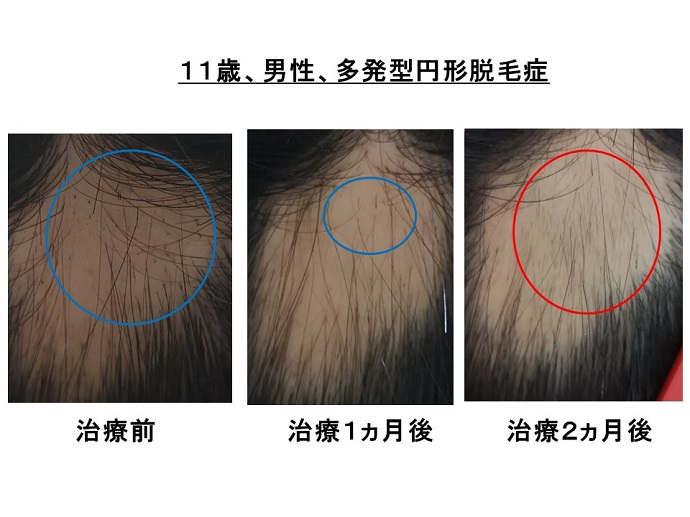 円形脱毛症　病院